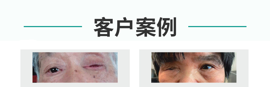 義眼片定做成功案例